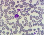 macro platelets