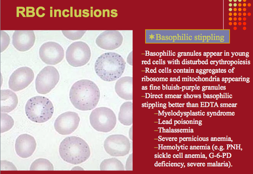 Basophilic Stippling Thalassemia