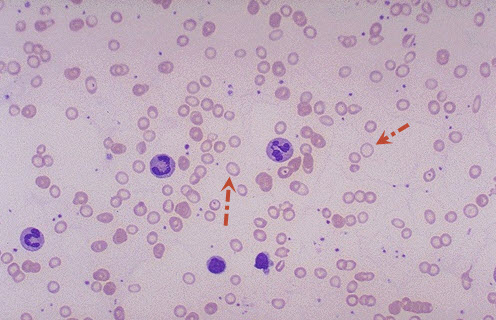 Hypochromic and Microcytic Red Cells