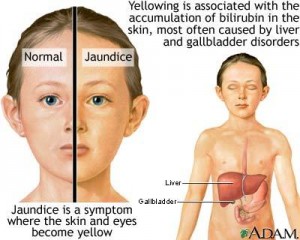 Jaundice Symptoms