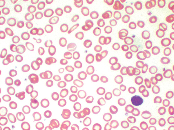 Microcytic hypochromic anemia caused by iron deficiency