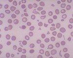 Schistocyte - Helmet Cells