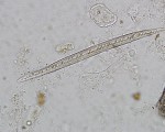 Plant hair confused for the larvae of hookworm or Strongyloides stercoralis
