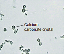 Calcium carbonate crystals | Medical Laboratories