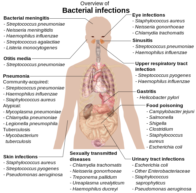 Overview of Bacterial Infections