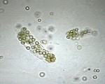 Red Cell Casts