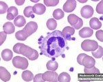 Several Platelets surround Neutrophil