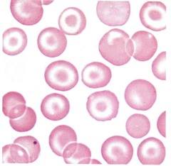 Target Cells (Codocytes) in a smear