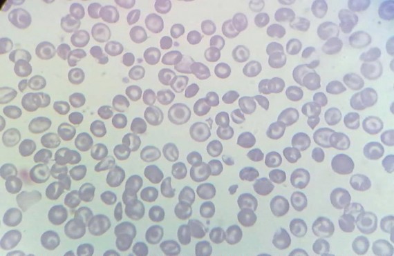 Target Cells or Codocytes in patient with Thalassemia