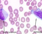 monocyte and reactive lymphocyte
