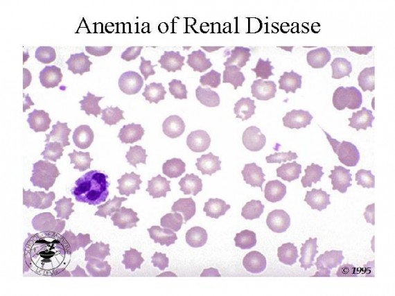 Anemia of Renal Disease