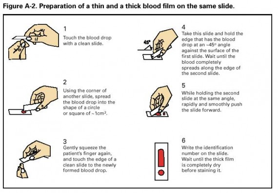 Preparation of a thin and a thick blood film on the same slide