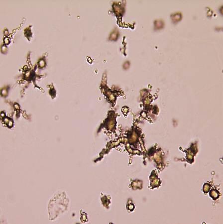 Ammonium biurate crystals in Alkaline Urine