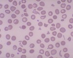 schistocytes