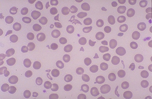 schistocytes