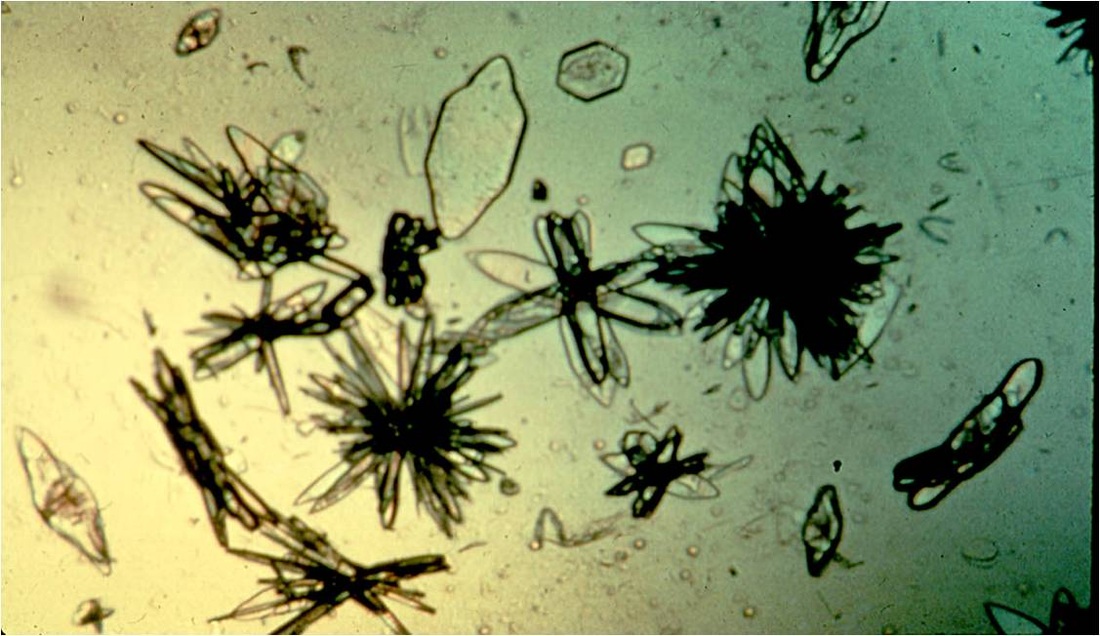 uric acid crystals