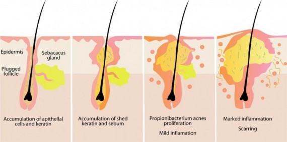 Propionibacterium acnes in sebaceous glands