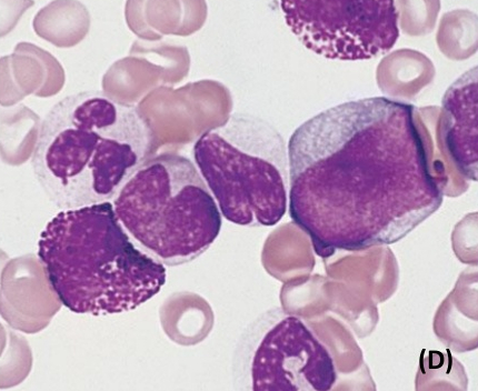 Chronic myeloid leukemia (CML)