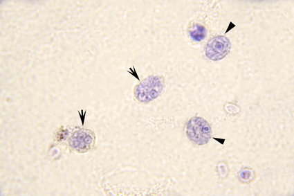 Mixed infection. Bailenger's stain. Two Entamoeba hartmanni trophozoites (arrow) and two Endolimax nana trophozoites (arrowhead)
