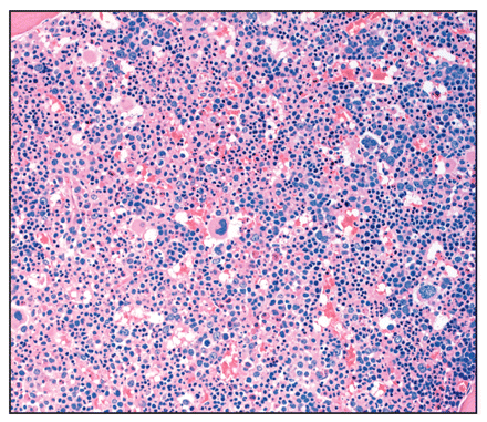 Hypercellular bone marrow sample showing prominent erythroid hyperplasia and scattered, increased megakaryocytes of varying sizes and shapes 