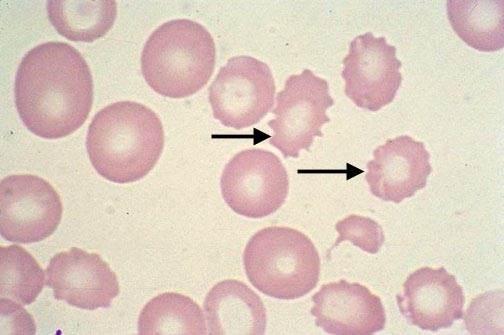 Echinocyte (Burr Cell)