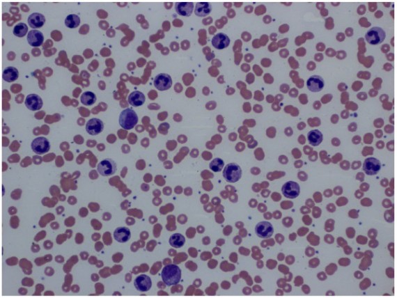 Leukocytosis