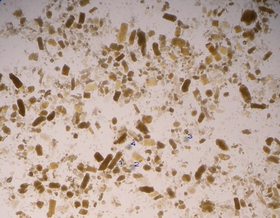  1: Muddy brown cast  (dirty brown hemoglobinuric pigment) 2: Waxy cast 3: Necrotic RTC cells 4: RTC-hyaline cast