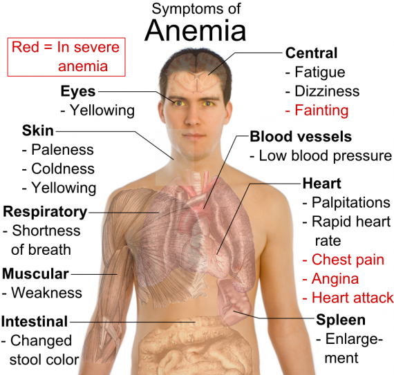 Signs and symptoms of anemia