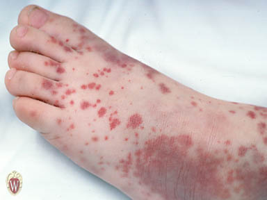 The palpable purpura on the foot of this nearly 3-year-old boy are associated with the disease Henoch-Schönlein Purpura. 
