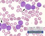 Acyute Lymphoblast leukemia (ALL) - Blasts