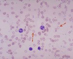 Hypochromic and Microcytic Red Cells