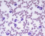 Neutrophilia - leukemoid reaction