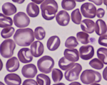 Stomatocytes - Hereditary stomatocytosis case