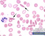 sickle cells - Sickle Cell Disease