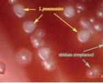 Streptococcus pneumoniae and viridans colonies