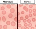 Normal and Macrocytic RBCs Comparision