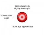 Target Cell Appearance (Bull's Eye)