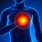 Heart Attack - Cardiac Markers